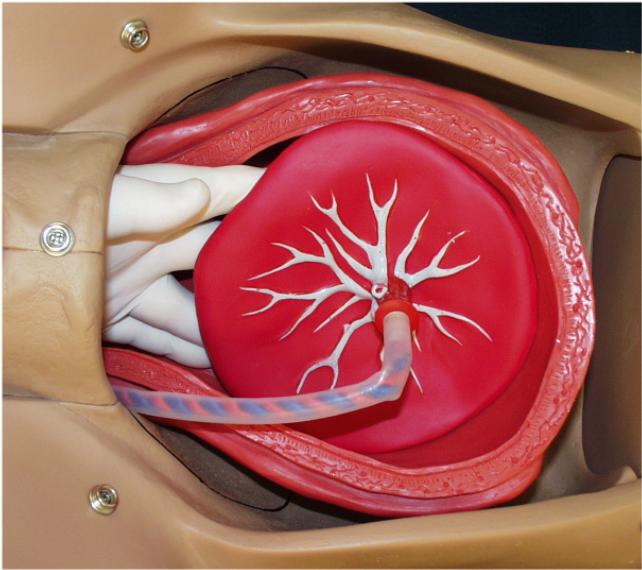 retained-placenta